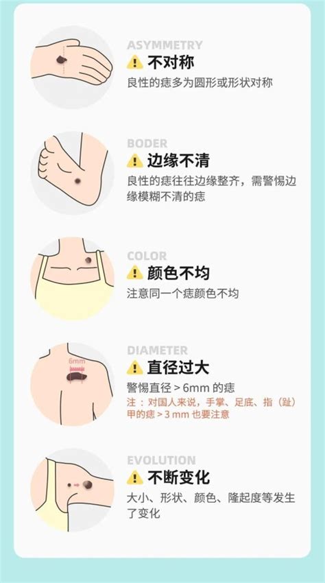 手臂長痣|痣也可能会癌变！长在 3 个地方要注意